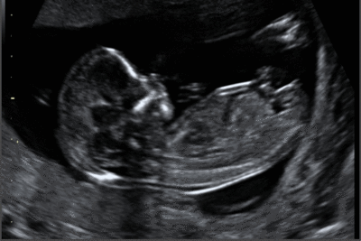 11-13. weekly ultrasound screening