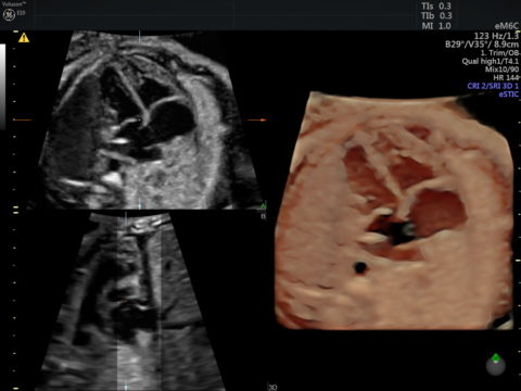 fetal heart ultrasound